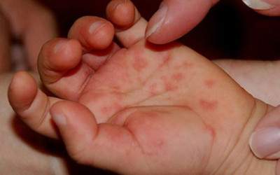 Bệnh Tay Chân Miệng Ở Trẻ Em