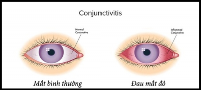 Bệnh Đau Mắt Đỏ