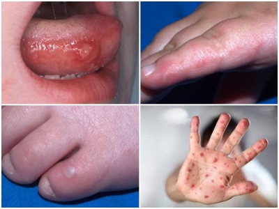Những bệnh thường gặp ở trẻ trong mùa hè