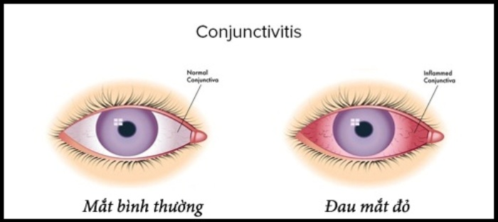 Bệnh Đau Mắt Đỏ